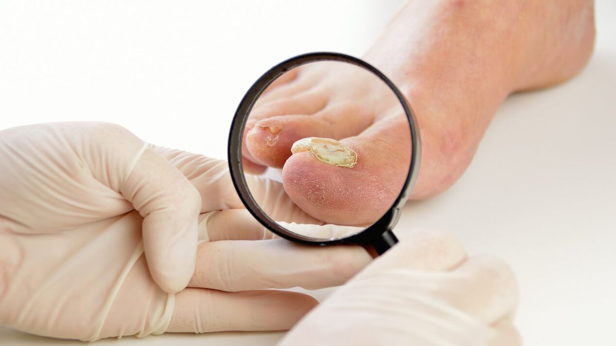 Nail fungus treatment with Keramin cream