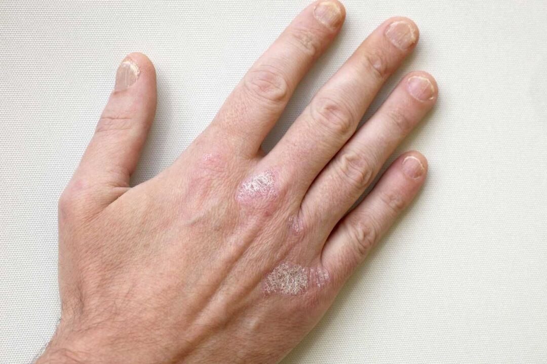 Psoriasis on the hands of a man treatment with cream Keramin