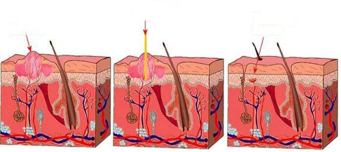 How the laser works on papilloma