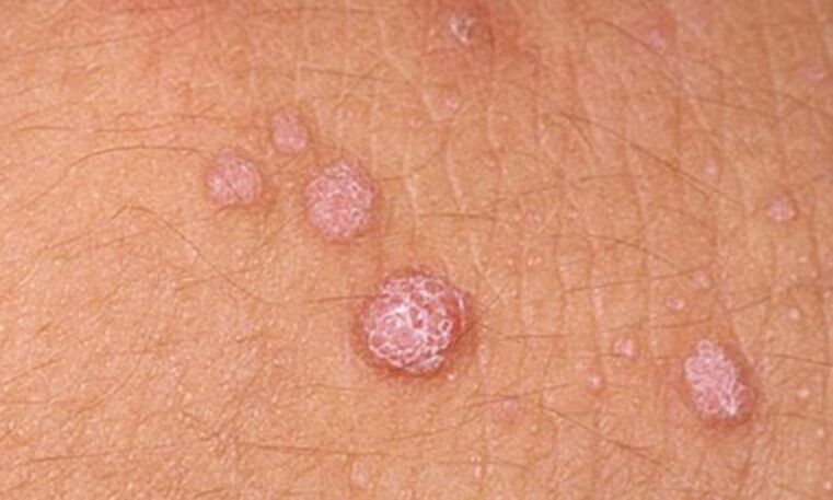 HPV leads to the appearance of skin papillomas