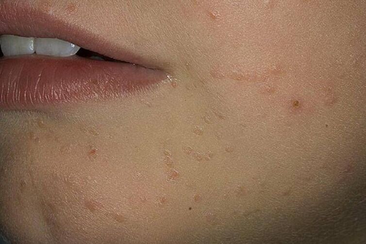 Papilloma on the face
