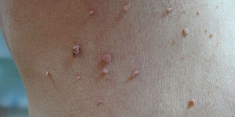 Papilloma