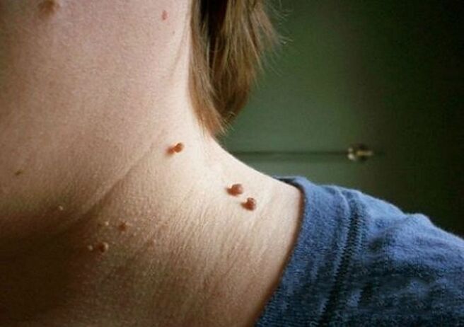 neck papilloma