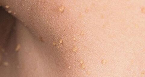 How does the human papillomavirus appear