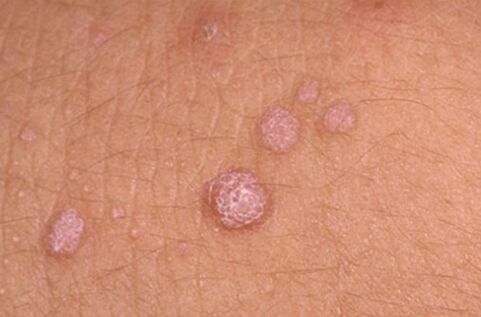 Symptoms of human papillomavirus