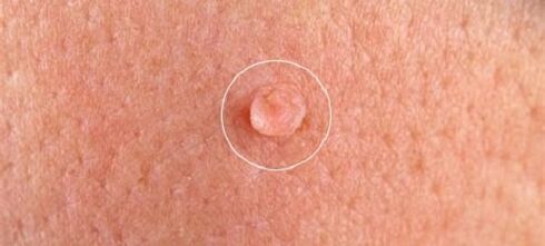 genital warts on the body