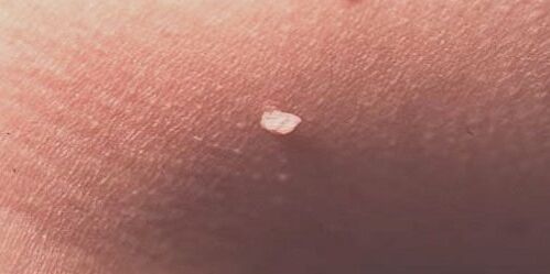 human papillomavirus in the skin