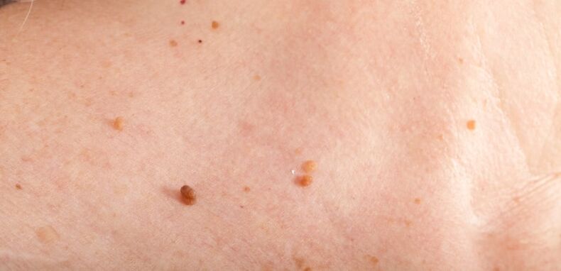 Papilloma on the body
