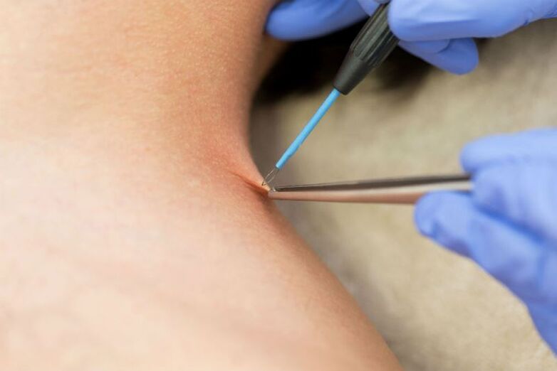 Procedure for removal of papilloma using electrocoagulation