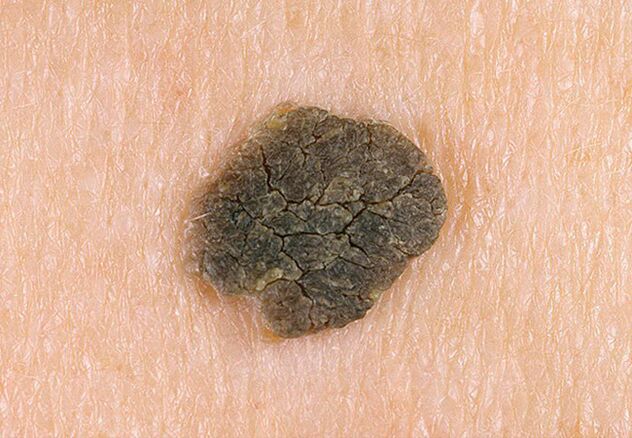 black wart on the skin