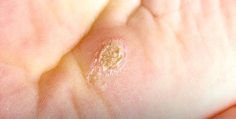 Plantar warts (spinal warts)