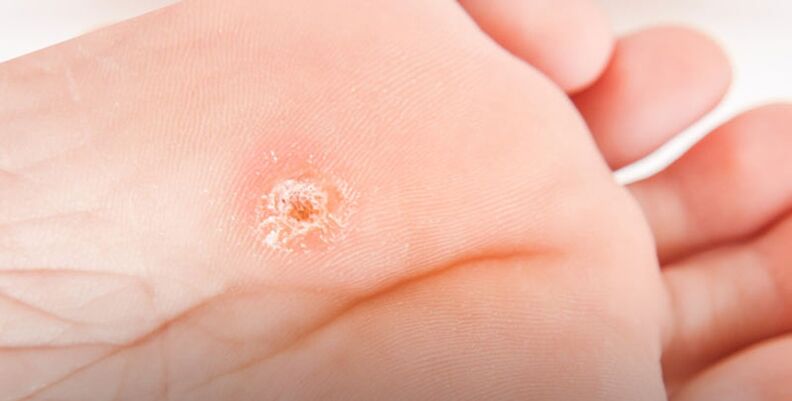 Plantar warts on feet
