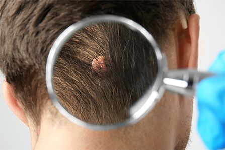papilloma on the head