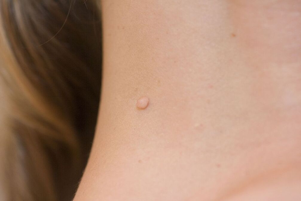 Symptoms of HPV