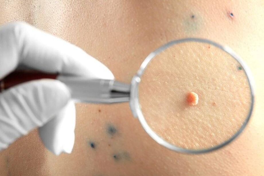 Treatment of HPV
