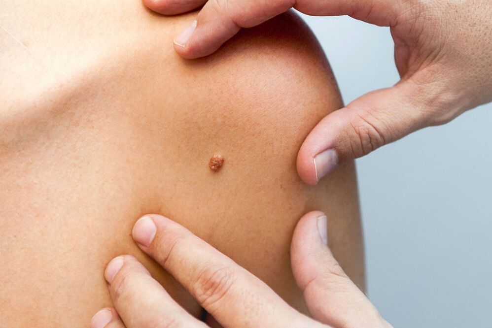 papilloma in the human body