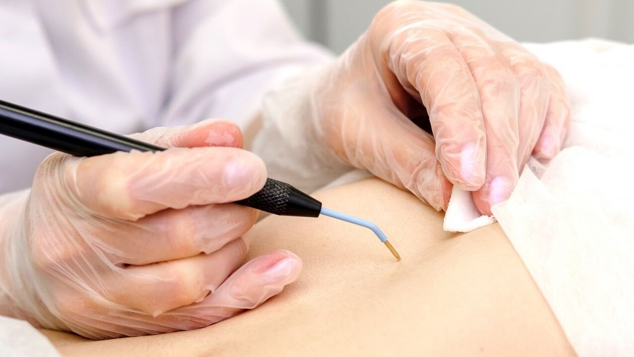 Ways to remove papillomas