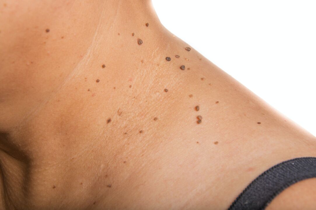 a distribution of papillomas on the neck