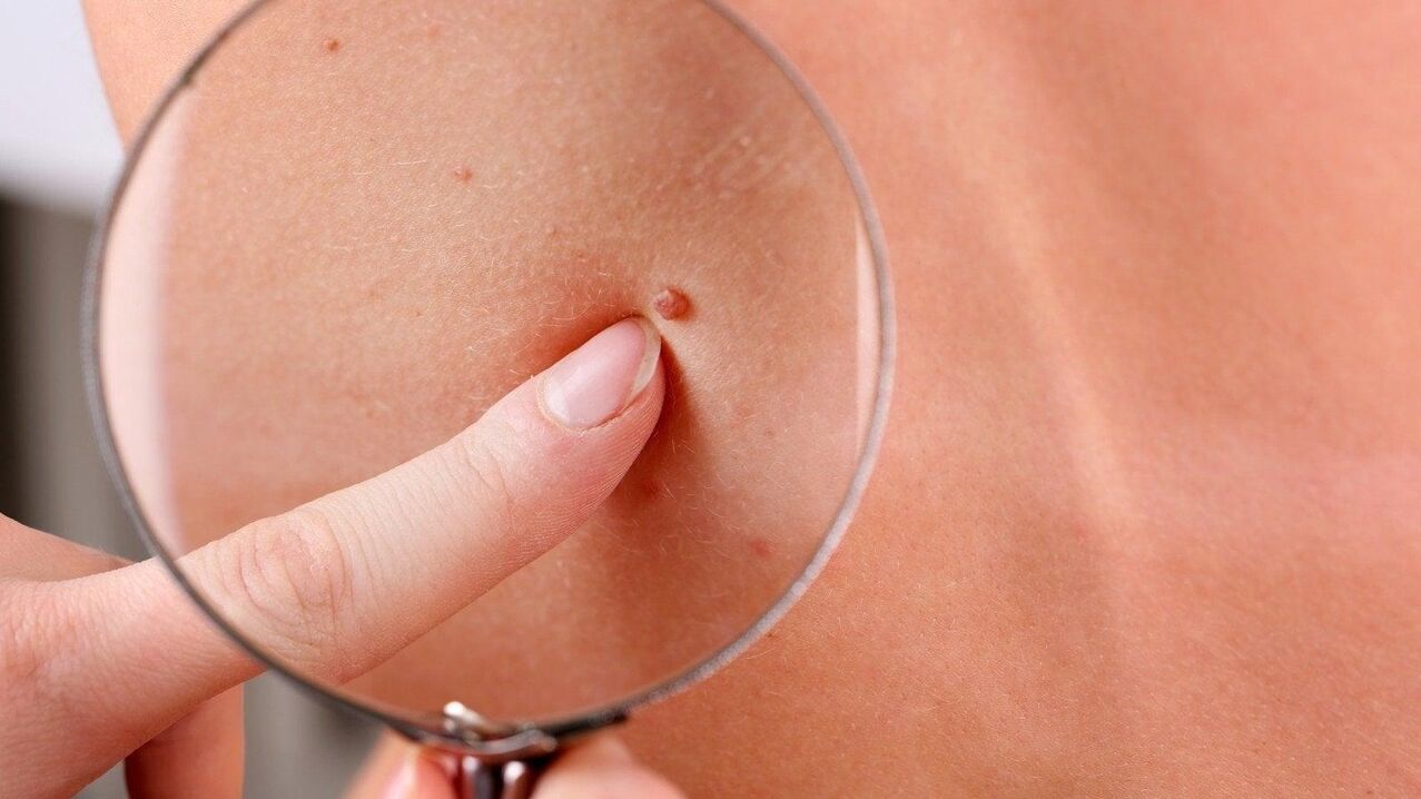 papilloma in the axillary area