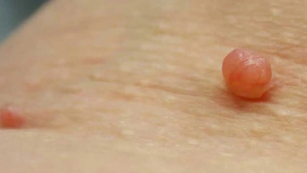 removal of papillomas at home